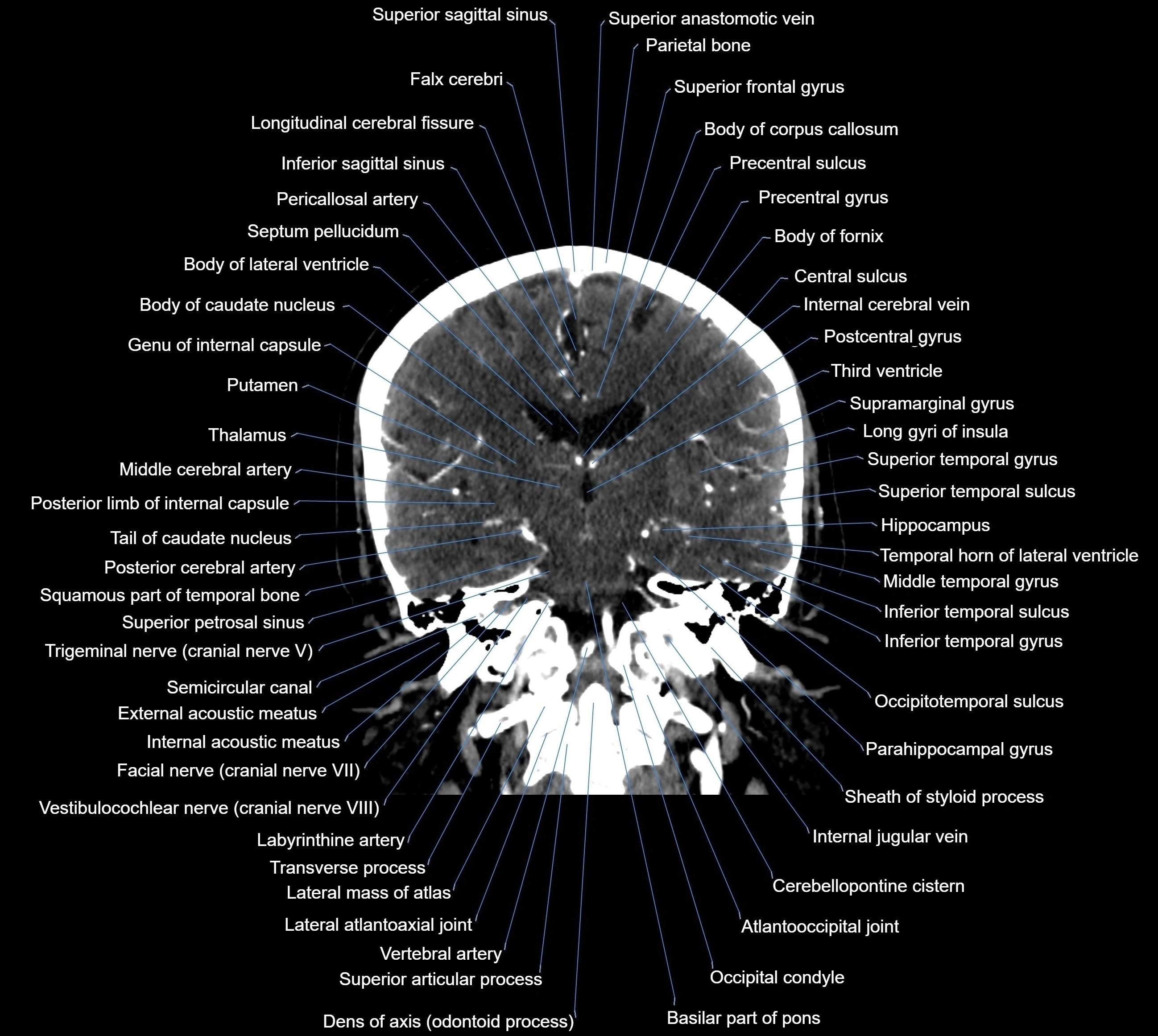 CT Brain coronal cross sectional radiology anatomy image  -img-00001-026.webp